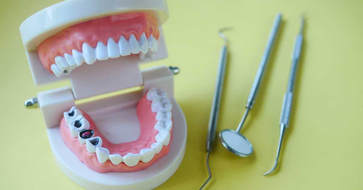 Restaurações Escuras de Metal