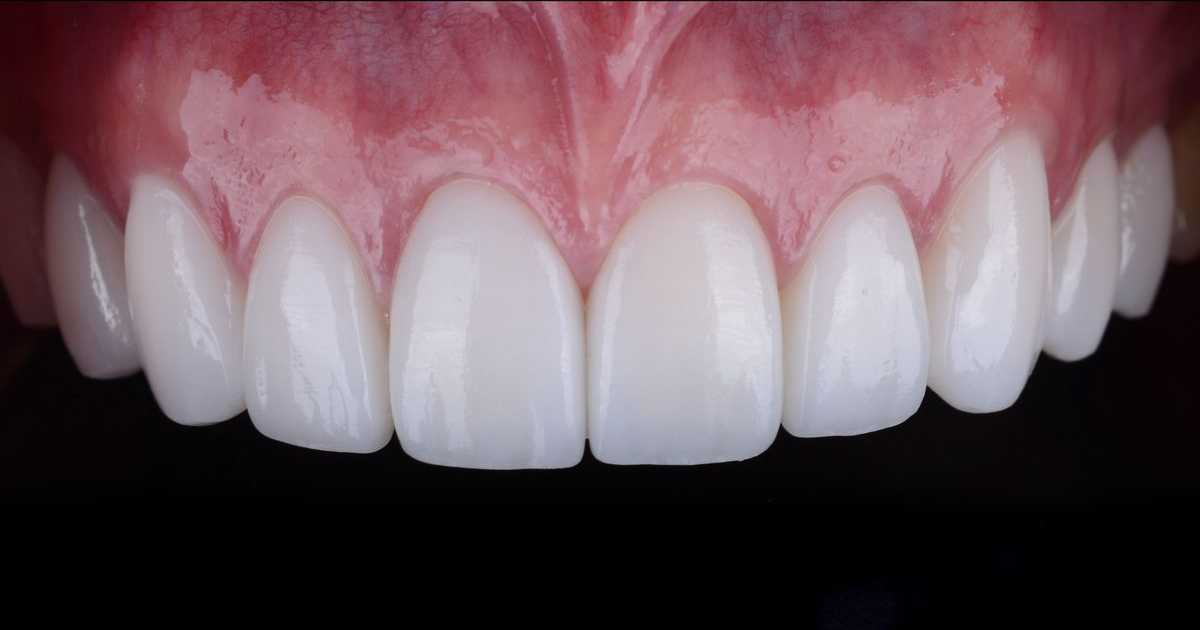 Clareamento Dental X Café