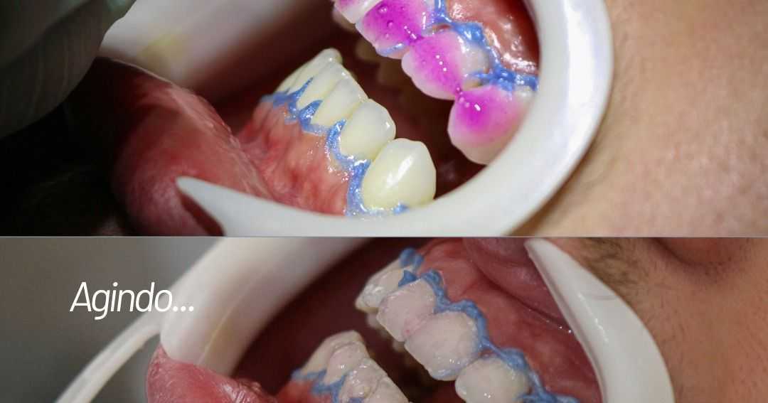 Clareamento de Consultório