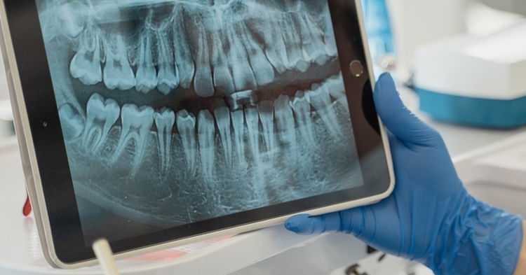 Eu preciso tirar meus sisos?